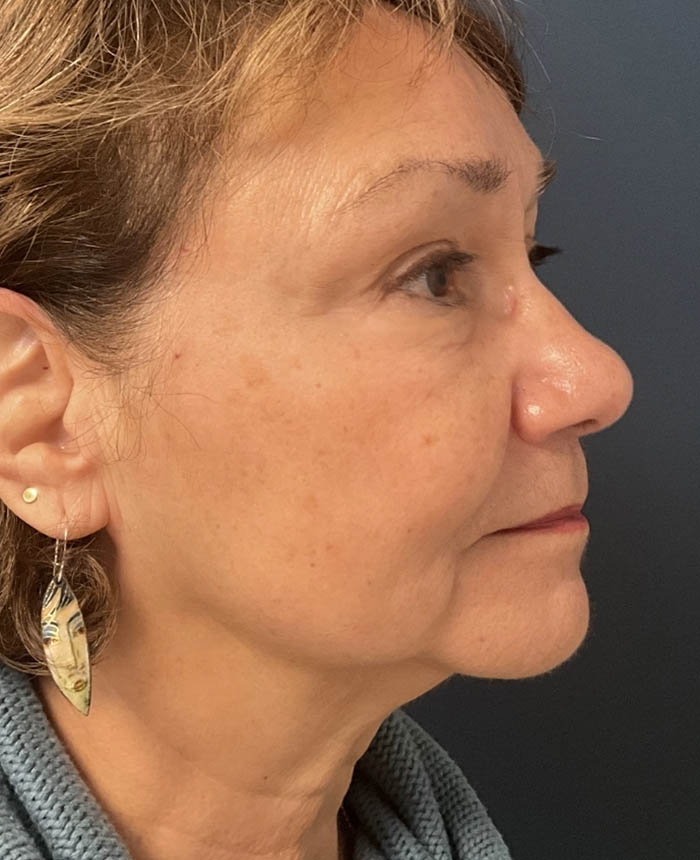 Facelift case #12928