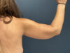After Weight Loss case #13264