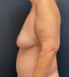 Breast Lift case #13489