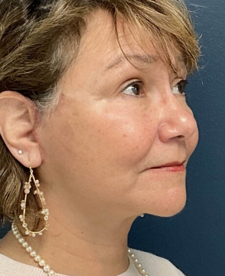 Facelift case #12928