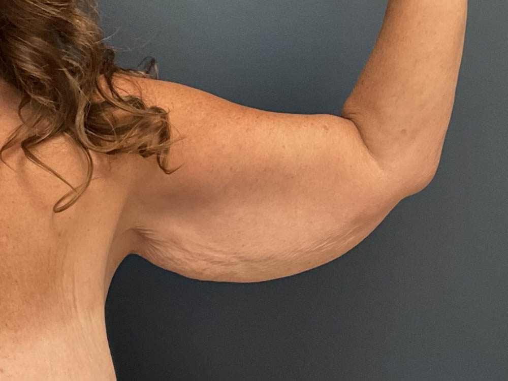 Arm Lift case #13264