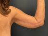 After Weight Loss case #13264