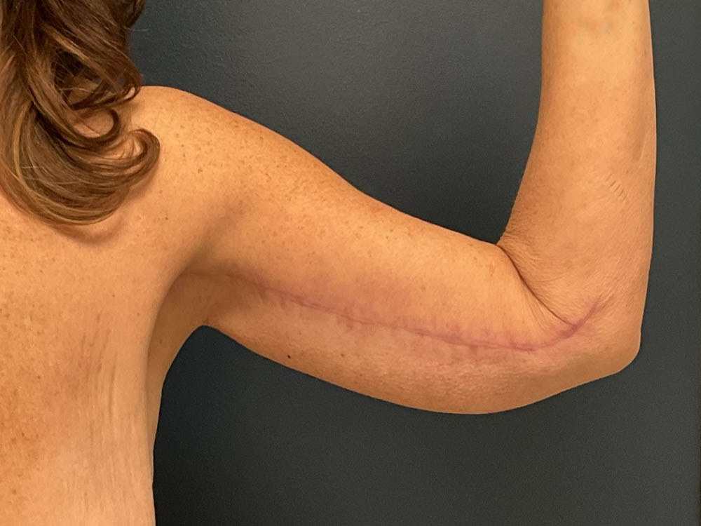Arm Lift case #13264