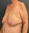 Breast Lift case #13489