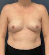 Breast Augmentation case #13196