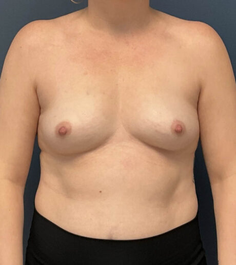 Breast Augmentation case #13196
