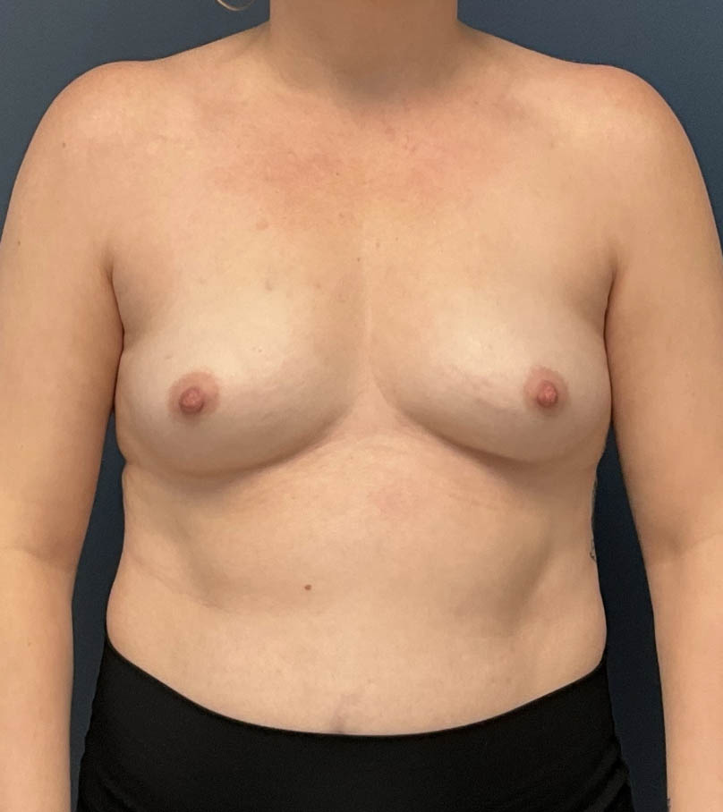 Breast Augmentation case #13196