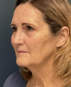 Facelift case #12947
