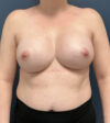 Breast Augmentation case #13196
