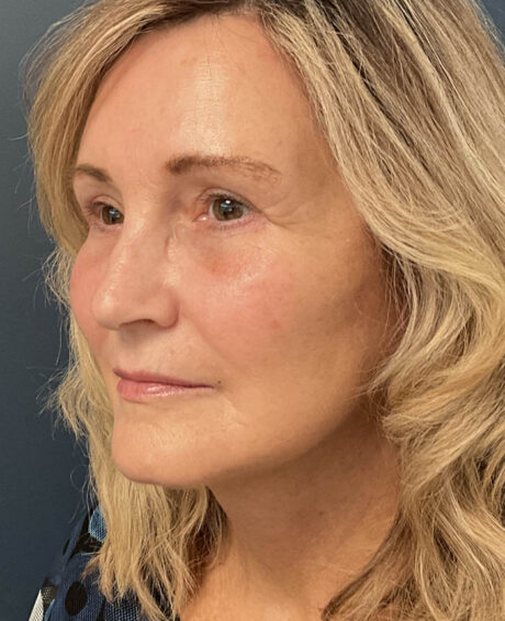 Facelift case #12947