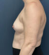 Breast Augmentation case #13196