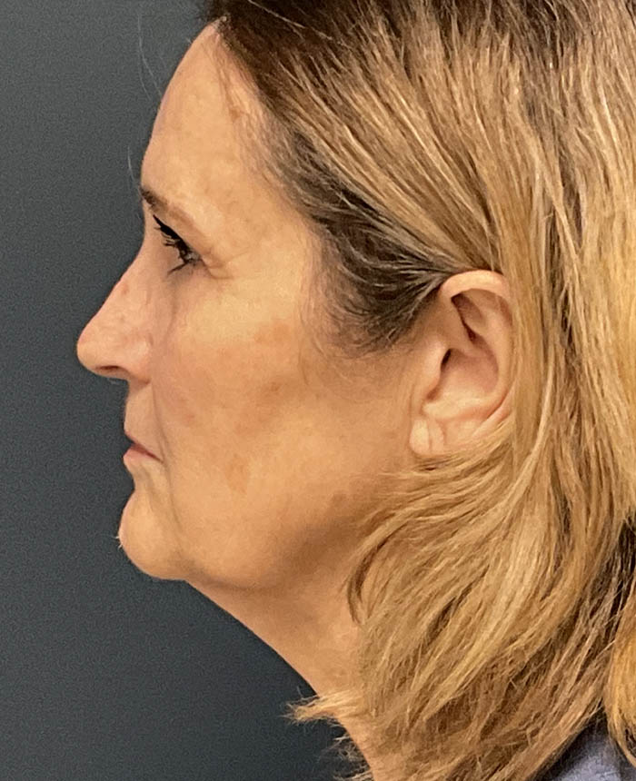 Facelift case #12947