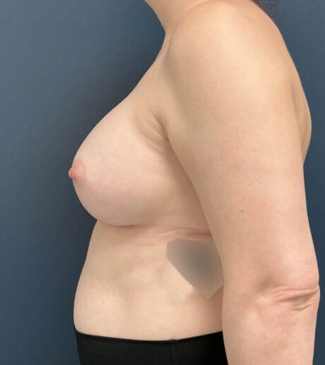 Breast Augmentation case #13196