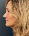 Facelift case #12947