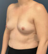 Breast Augmentation case #13196