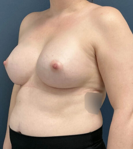 Breast Augmentation case #13196