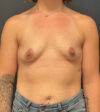 Breast Augmentation case #13014