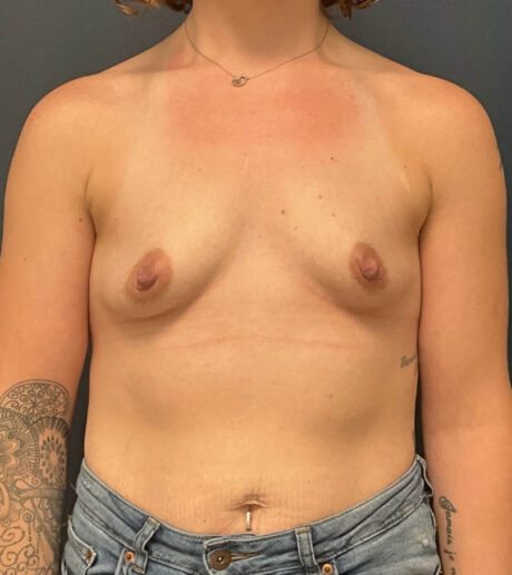 Breast Augmentation case #13014