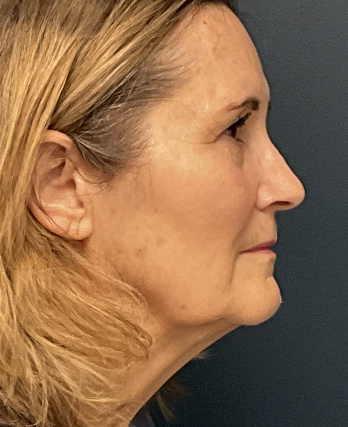 Facelift case #12947