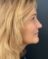 Facelift case #12947