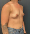 Breast Augmentation case #13014
