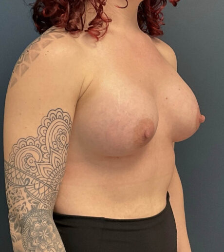 Breast Augmentation case #13014