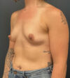 Breast Augmentation case #13014