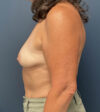 Breast Augmentation case #13211