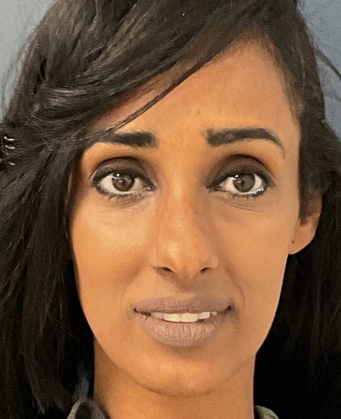 Rhinoplasty case #12940