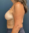 Breast Augmentation case #13211