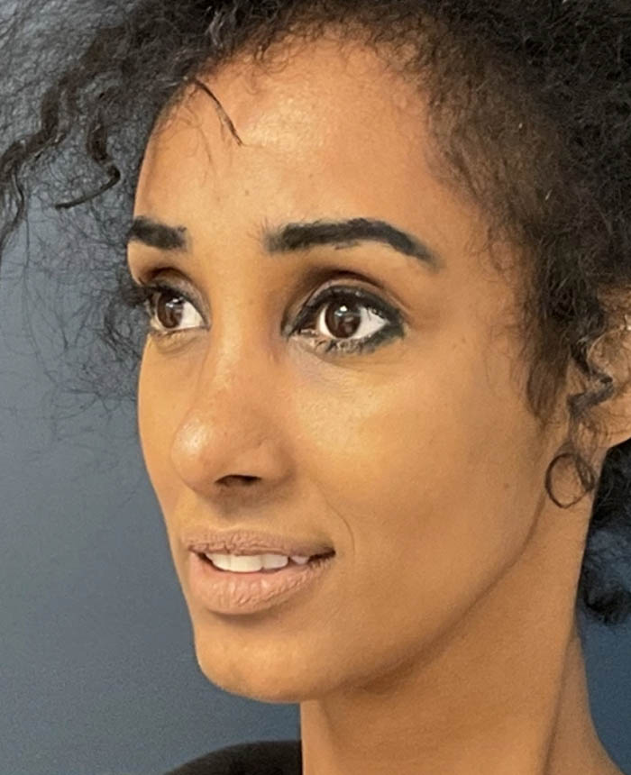 Rhinoplasty case #12940