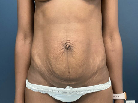 Tummy Tuck case #12914