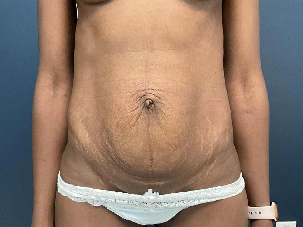Tummy Tuck case #12914