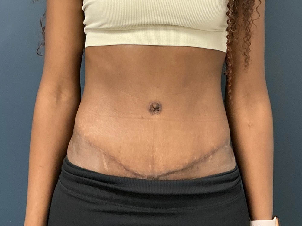 Tummy Tuck case #12914