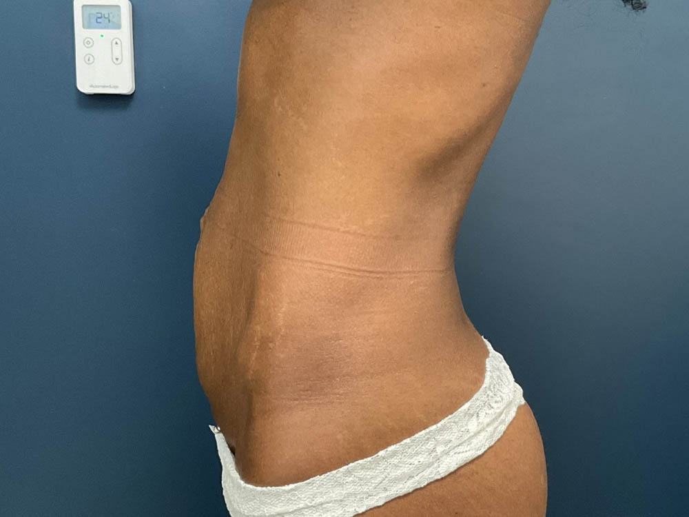 Tummy Tuck case #12914