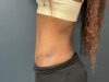Tummy Tuck case #12914
