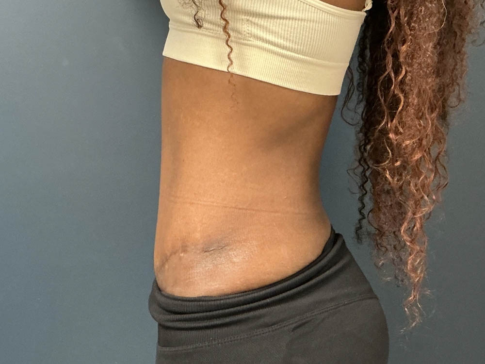 Tummy Tuck case #12914
