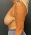 Breast Augmentation case #13219