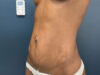 Tummy Tuck case #12914
