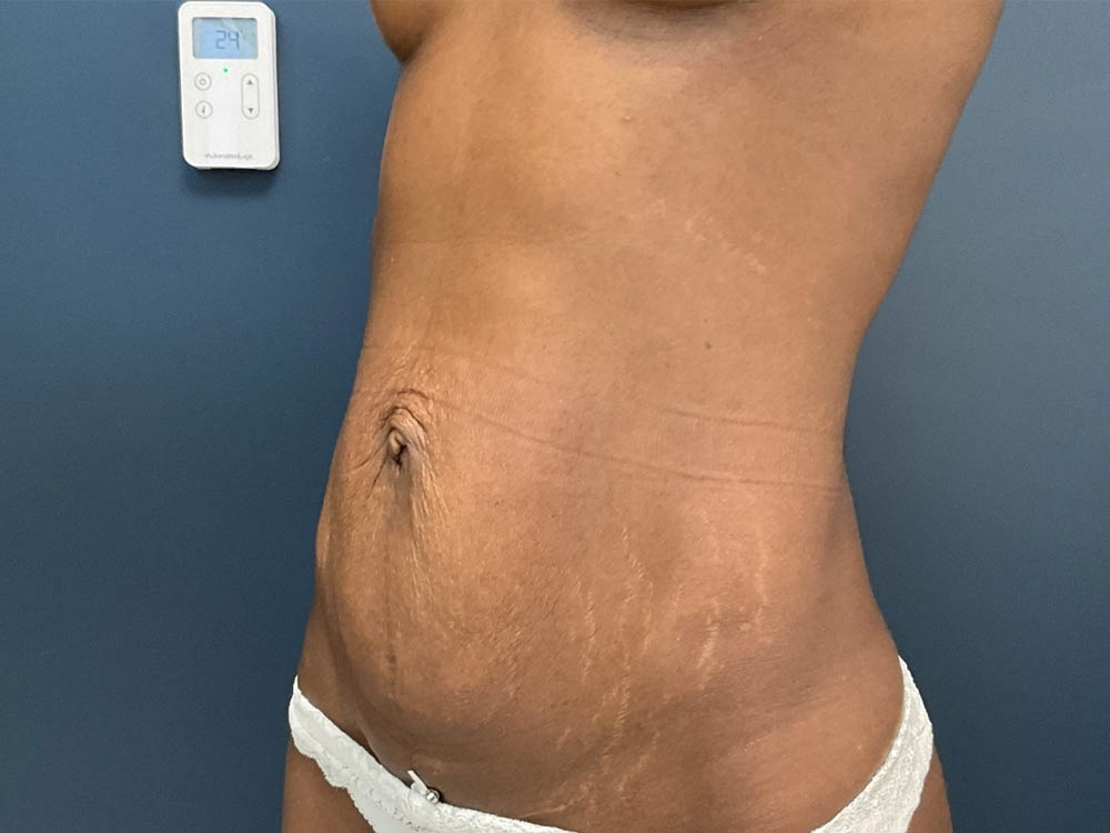 Tummy Tuck case #12914