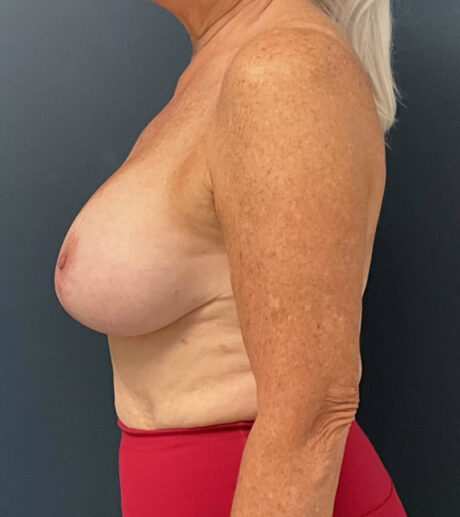 Breast Augmentation case #13219