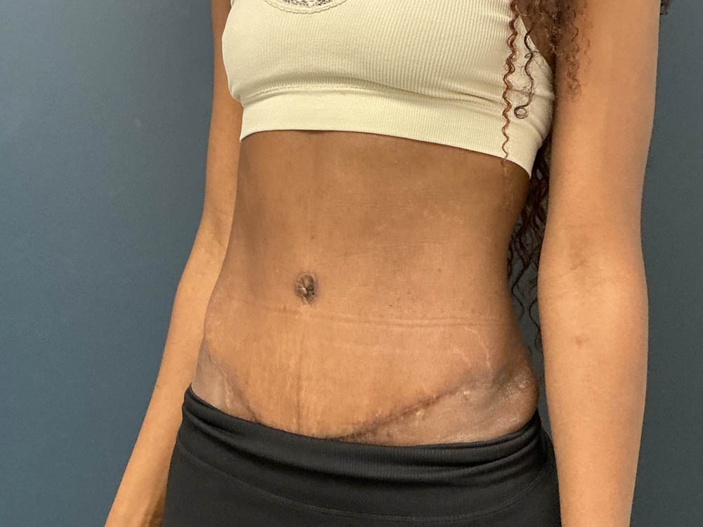 Tummy Tuck case #12914