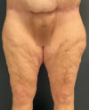 Thigh, Buttock, & Arm Lift case #13481
