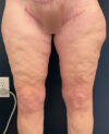Thigh, Buttock, & Arm Lift case #13481