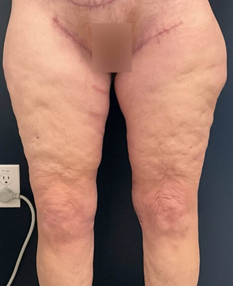 Thigh, Buttock, & Arm Lift case #13481
