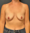 Breast Augmentation case #13180