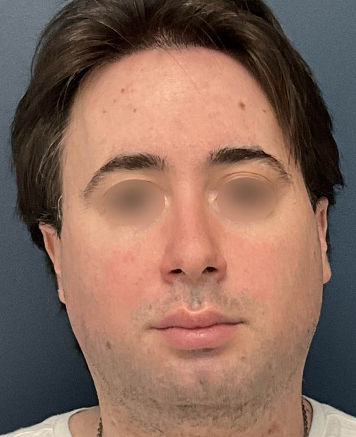 Facial Feminization Surgery case #13939