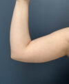 Liposuction case #13953