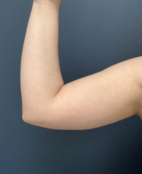 Liposuction case #13953