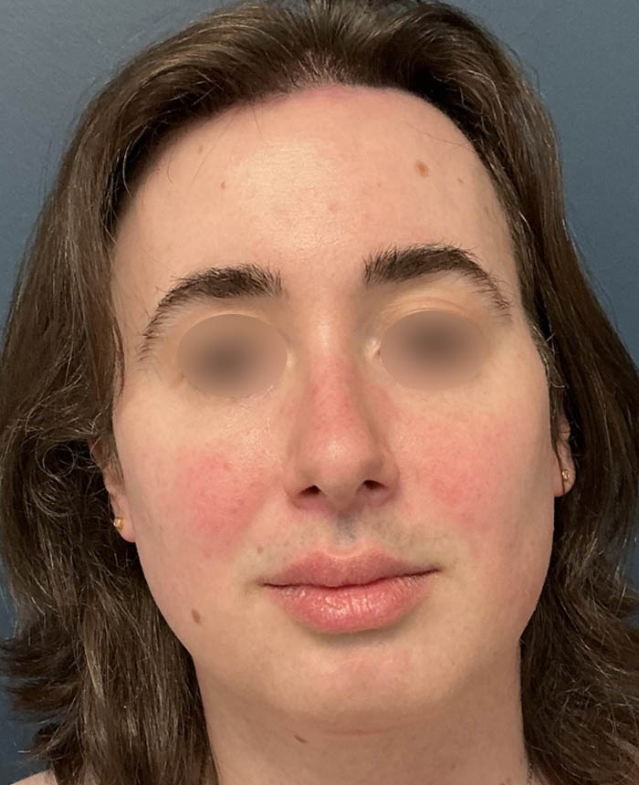 Facial Feminization Surgery case #13939